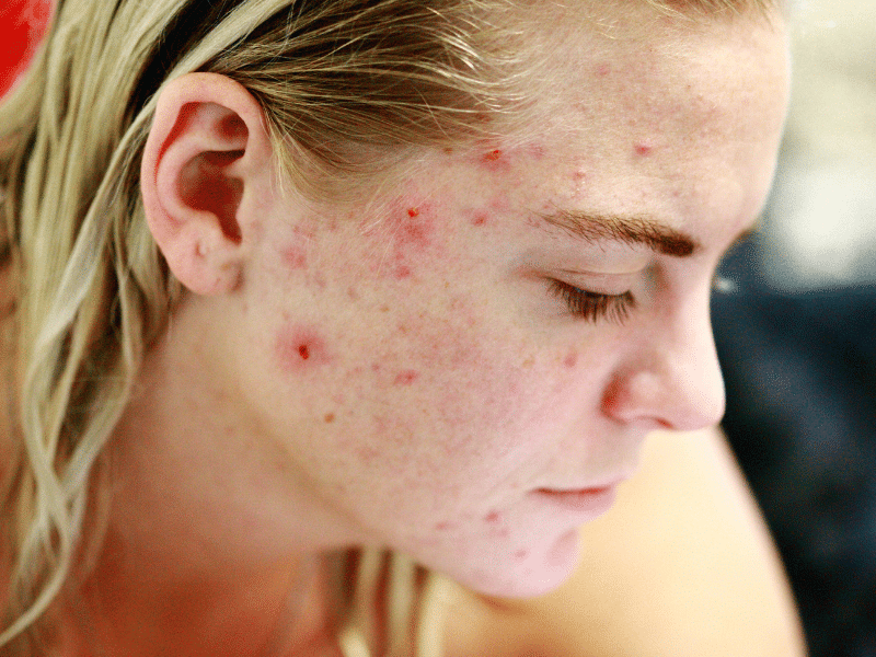 Acne adolescenziale